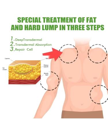 YSGBYSG LipomaCure Ointment 20g - 5PCS | Lump-Free Lipoma Removal Cream for Skin Anti-Swelling - Buy Online on GoSupps.com
