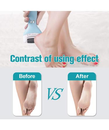 MYCARBON Electric Feet Callus Remover - Rechargeable & Waterproof Foot File for Professional Dead Skin Removal Pedicure Tools Kit for Hard Cracked Feet - Buy Online on GoSupps.com