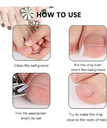 Ingrown Toenails Set Nail Correction Clip Toenail Correction Set Ingrown Toenail Correction Patch for Paronychia Ingrown Toenails Protects Toenails - Buy Online on GoSupps.com