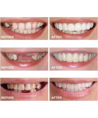 2 Pairs Temporary Nature and Comfortable Adjustable for Men and Women Beautiful Smile(White) (4) - Buy Online on GoSupps.com