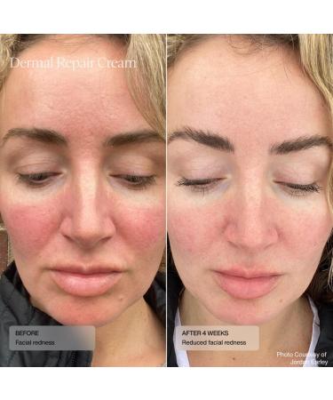 Sent Dermal Repair Facial Cream - Hydrate & Renew Sensitive Rosacea-Prone Skin with HSA Vitamin E & Green Tea - 1.7 Fl Oz - Buy Online on GoSupps.com