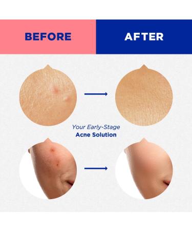 FANOFI Micro-needle Acne Soothing Patch | Fast-Acting Patches for Early-Stage & Deep Pimples | Salicylic Acid with Madecassoside & Witch Hazel | 1 pack (9 patches) - Buy Online on GoSupps.com