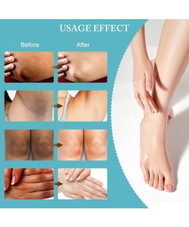 Fengyang Acanthosis Nigricans Cream Anti-Dark Spots Cream Correcting Cream for Elbow Knee Joint - Buy Online on GoSupps.com