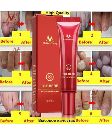 Herbal Foot Nail Cream Protector Skin Care Cream Ointment Treatment Toe Nail Onychomycosis Paronychia Anti Fungal Treatment Nail Repair Cream 15g - Buy Online on GoSupps.com