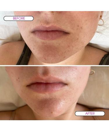 Clear Skin Days Mattifying Barrier Moisturiser - Blemish & Acne Treatment Gel For Oil Control - Reduce Blemishes Protect and Hydrate Skin Control Sebum Production - Reduces Inflamed Acne - 50ml - Buy Online on GoSupps.com