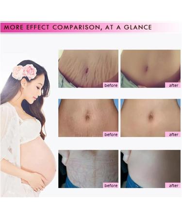 Scar Prevention & Stretch Mark Repair Essential Oil - Premium Beauty Solution for Women | Shop Now! - Buy Online on GoSupps.com