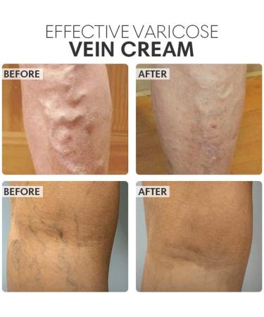 Buy Ttcpuysa Varicose Veins Cream - 2PCs Vein Healing Treatment Soothing Anti-Varicose Cream for Improved Blood Circulation (20g) - Buy Online on GoSupps.com