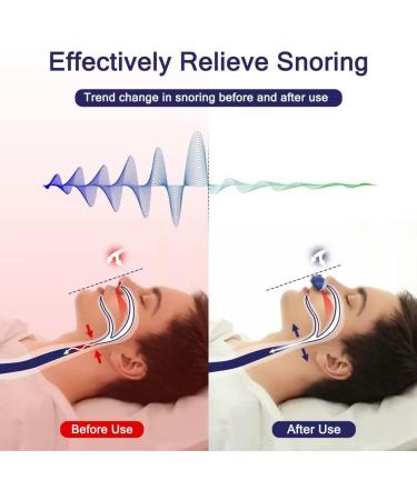 ROOHO Adjustable Electric Anti Snoring Device - Stop Snoring Solution for Men and Women - Nasal Dilator Nose Vents Plugs - Buy Online on GoSupps.com