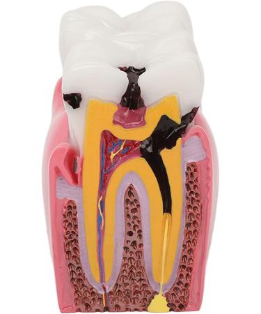 Tooth Caries Model - 6x Enlarged Caries Demonstration for Dental Education | International Shipping - Buy Online on GoSupps.com