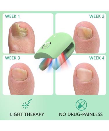 Nail Fungus Laser Treatment Device - Home Use onychomycosis Remover with 470nm Blue Light 660nm Red Light & 905nm Infrared Light - Buy Online on GoSupps.com