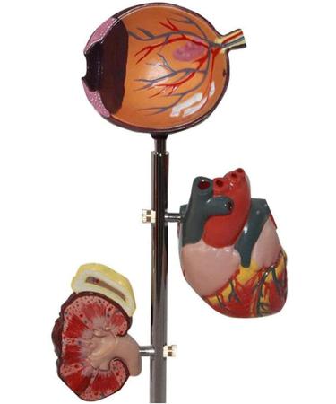 Dytah Pathological Diabetes Model - 5-Part Educational Kit for Eye Heart Kidney Artery & Foot Training | International Shipping Available - Buy Online on GoSupps.com