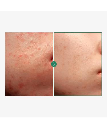 NATUREONE BHA Acne Foam Cleansing, Acne Face Wash, Salicylic Acid for Acne Prone Skin, Exfoliator, Sebum, Blackhead Remover and Dead Cells, Foaming Pore Cleanser, Korean Skincare, 100ml, 3.38 fl.oz. - Buy Online on GoSupps.com