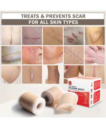 Everlit Silicone Scar Sheet | Medical Grade Skin Repair Strips for C-Section Acne Surgery | Soft Reusable Gel Tape | 1.6 x 60 Roll - Buy Online on GoSupps.com