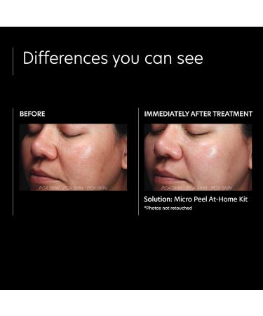 PCA SKIN Micro Peel Kit | Dark Spot & Hyperpigmentation Corrector | Lactic Acid Brightening Treatment & SPF 50 - Buy Online on GoSupps.com