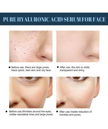 KKPLZZ 60 PCS Soluble Protein Thread Lifting Collagen Silk Threads for Skin Lifting Tightening Collagen Silk Threads for Lifting Skin Tightening and AntiAging - Buy Online on GoSupps.com