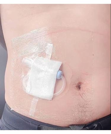 Waterproof Shower Cover Shields for Dialysis Port & Catheters - 25 Pack Shower Protector for Picc Line Chemo Port Feeding Tube & G-Tube Patients - Buy Online on GoSupps.com