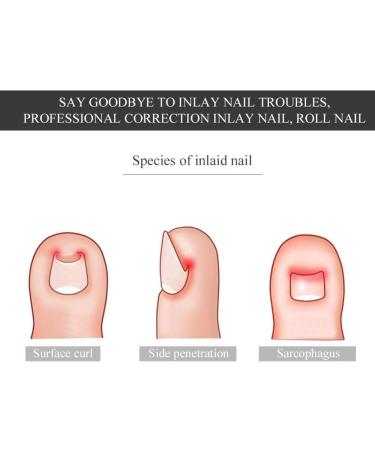 Nail Corrector Pedicure Tool - 12Pcs/Box Toenail Correction Kit for Ingrown Nails - Foot Care Fixer in 6 Sizes - Buy Online on GoSupps.com