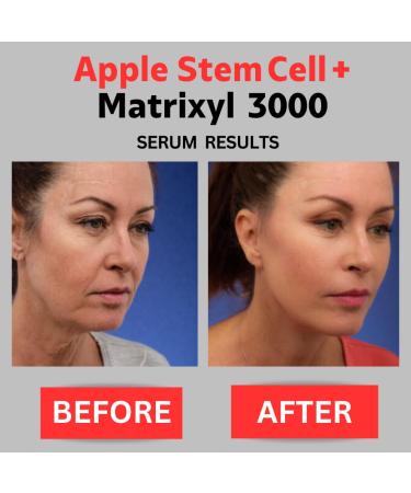 Apple Stem Cell & Matrixyl 3000 Anti-Aging Serum with Hyaluronic Acid - 4 oz Peptide Face Serum for Wrinkles & Skin Care - Buy Online on GoSupps.com