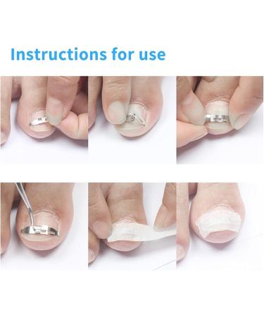 Ingrown Toenail Treatment Stainless Steel Ingrown Toenail Corrector Relief Paronychia Treatment Correcting Tool - Buy Online on GoSupps.com