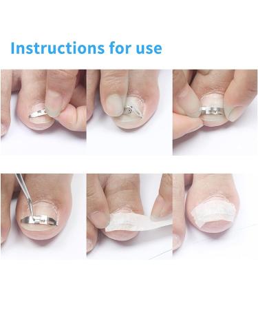 Ingrown Toenail Treatment Kit for Pain Relief - Paronychia Corrector Tool Set for Salon and Home Use - Buy Online on GoSupps.com