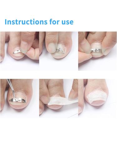 1PC Adjustable Stainless Steel Nail Corrector | Foot Care Tool for Ingrown Toenails & Paronychia Treatment (17mm-22mm) - Buy Online on GoSupps.com