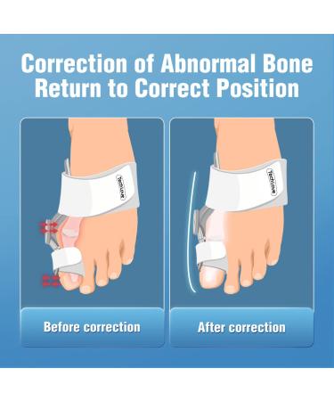 Tech Love Bunion Corrector - Orthopedic Bunion Toe Straightener for Women and Men | Adjustable Bunion Splint with Toe Separator for Day Night Support | Bunion Relief (1PC) - Buy Online on GoSupps.com