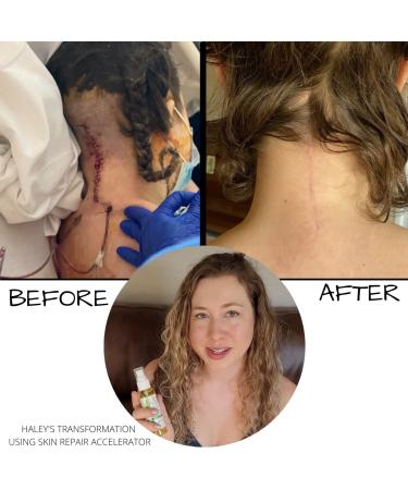Brittanie's Thyme Skin Repair Accelerator for Scars & Stretchmarks | Natural Non-Toxic Treatment, Dermatologist Recommended for Deep Nourishment, Wrinkle Reduction, and Itchy Skin - Ideal for Damaged Skin & Tattoos - Buy Online on GoSupps.com