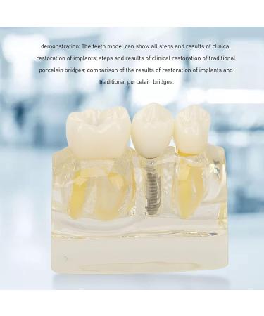 Verdant Touch Dental Implant Model | Transparent Dental Implant for Teaching & Research | International Shipping - Buy Online on GoSupps.com