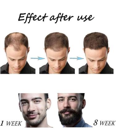 Derma Beard Growth Roller 540 Titanium Microneedle Derma Roller Hair Growth Skin Care Face Roller for Reducing Face Facial Wrinkles Fine Lines and Beauty Tool for Women & Men (1.5mm) - Buy Online on GoSupps.com