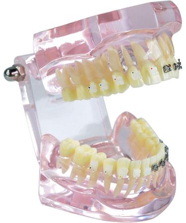 Buy Liusu Children's Tooth Theory Dental Model - Transparent Implant & Orthodontic Demo Model with Self-Ligating Clips | International Shipping Available - Buy Online on GoSupps.com