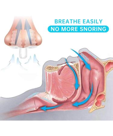 10 Pcs Anti Snoring Nose Vents Clips - Nasal Dilators for Breathing Relief and Snore Stopper - Buy Online on GoSupps.com