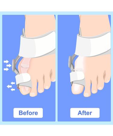 KOTALS Bunion Corrector Brace Splint Pads & Toe Separators - White (1 Pack) - Buy Online on GoSupps.com