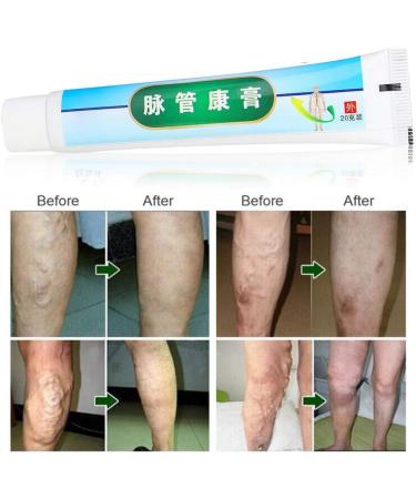 Varicose Veins Cream & Ointment for Relief | Phlebitis Angiitis & Inflammation Treatment - Buy Online on GoSupps.com