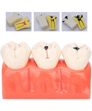Verdant Touch Simulation Teeth Caries Model - Removable Tooth Caries Demonstration for Dental Education | International Shipping - Buy Online on GoSupps.com