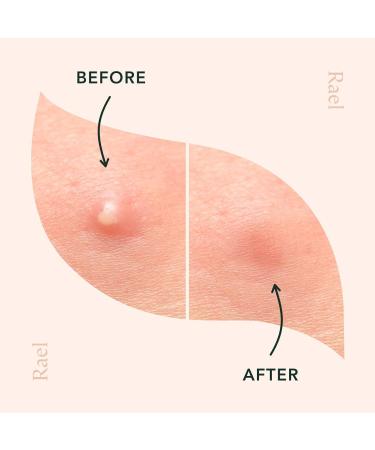 Rael Acne Pimple Healing Patch - Invisible Hydrocolloid Spot Treatment (96 Count, 10mm & 12mm) - Buy Online on GoSupps.com