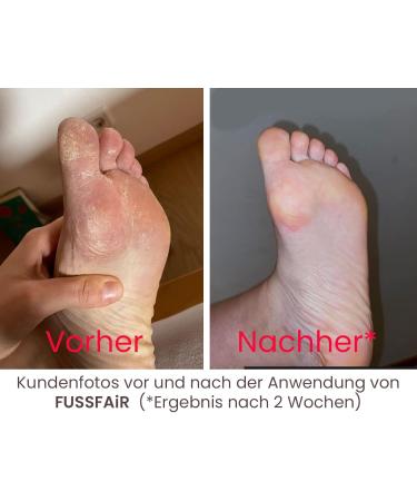 FUSSFAIR Callus Remover Balm Cream - Natural 30ml Callus Removal Solution | Softens Feet & Heels - Buy Online on GoSupps.com