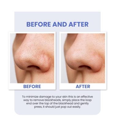 Buy Glamza Blackhead Remover Effective & Gentle 1 Piece Tool for Clear Skin | International Shipping Available - Buy Online on GoSupps.com