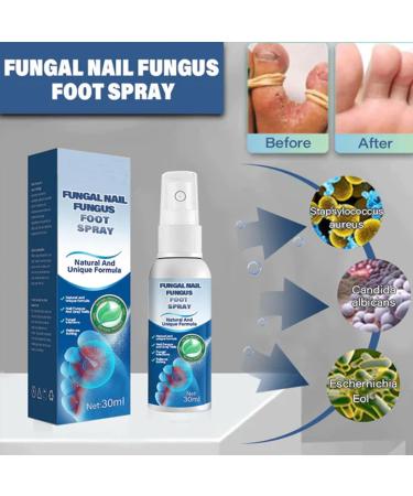 Medical Grade Athlete's Foot & Nail Treatment Spray - Easy to Use 30ml - Set of 2 - Buy Online on GoSupps.com