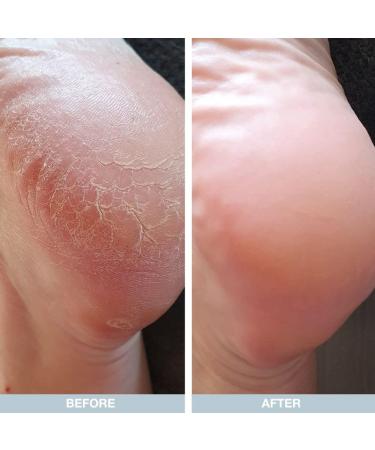 Australian Bodycare Cracked Heel Repair Cream 100ml | Tea Tree Oil + Lemon Myrtle | Hard Skin Remover | 25% Urea Cream | Heel Care for Dry & Cracked Feet - Buy Online on GoSupps.com