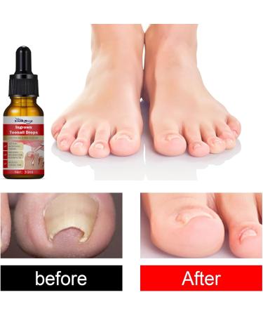 VIDIND Ingrown Toenail Correction Oil Ingrown Toenail Correction Drops Ingrown Cuticle Oil Fungal Nail Treatment and Repair for Fingernails and Toenails (1 pc 10ml) - Buy Online on GoSupps.com