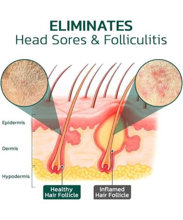 Scalp Folliculitis Treatment Oil Folliculitis Scalp Oil Nourishing Treatment for Split Ends and Dry Scalp for All Hair Types - Buy Online on GoSupps.com