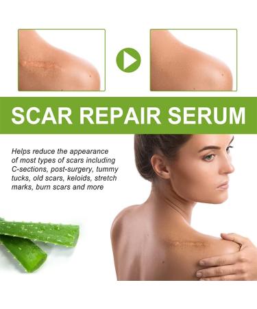 BOKIOESDE Women Hip Chest Stretch Mark Serum Body Burn Scars Serum Girls Skin Care Repair Essence Beauty Supplies - Buy Online on GoSupps.com