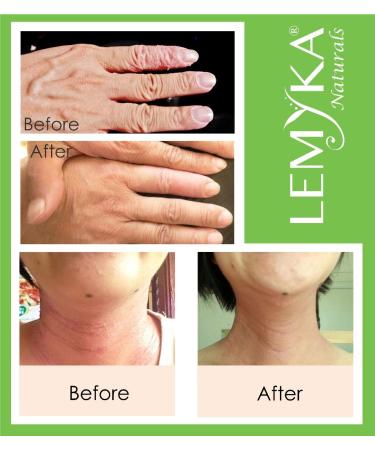 LEMYKA Eczema Flare Defense Calming Cream - 3 Pack Bundle | For Infants, Babies, Kids, & Adults with Atopic Dermatitis | Steroid-Free Formula - Buy Online on GoSupps.com