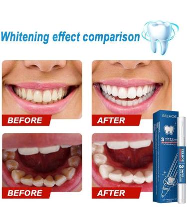 BBABBT Teeth Whitening Pen Professional Teeth Whitening Gel Natural Whitening Bleaching Treatments Effective Painless No Sensitivity3g - Buy Online on GoSupps.com