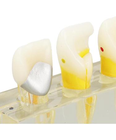 Professional Removable Zahnpulpa Model - Dental Endodontic Training Tool | Stable Resin for Students - Buy Online on GoSupps.com