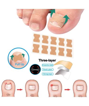 Ingrown Toenail Corrector Patch - 50PCS Natural Strips for Painless Treatment and Relief from Nail Groove - Glue-free Solution - Buy Online on GoSupps.com