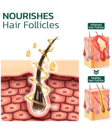 GFOUK Scalp Folliculitis Treatment Scalp Treatment Hair Oil Nourishing Treatment for Split Ends and Dry Scalp for All Hair Types - Buy Online on GoSupps.com