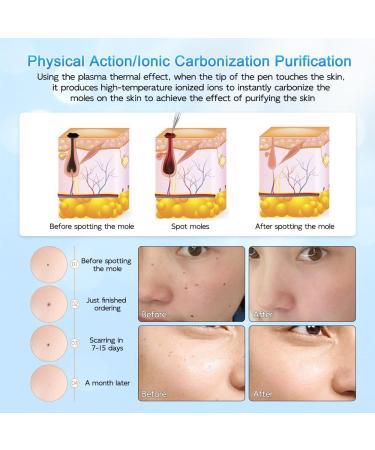KUWUNG Skin Tag Removal Pen Professional Mole Removal Pen Skin Tag Removal Kit with 9 Modes & LCD Display Portable USB Rechargeable Mole Remover Pen with Replaceable Needles for Mole Wart Dark Spot - Buy Online on GoSupps.com