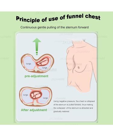 Pectus Excavatum Orthosis Brace for All Ages - Thoracic & Sternal Depression Support for Sunken Sternum Deformity | Shop Now - Buy Online on GoSupps.com