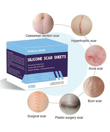 Medical Grade Scar Removal Silicone Tape (1.6x60 Roll) for Hypertrophic Scars & Keloids | Surgery, Injury, Burns, C-Section Crease | 2 Rolls - Buy Online on GoSupps.com